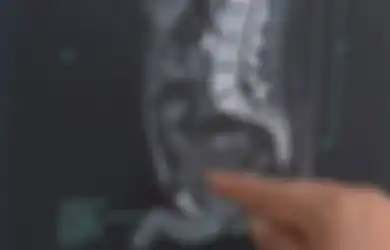 Minum 10 Gelas Bir dalam Semalam, Hal Mengerikan Terjadi Pada Tubuh Pria Ini