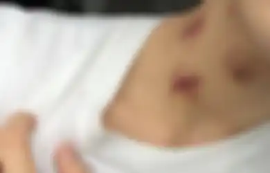 Remaja 17 Tahun Meninggal Karena Dicupang Pacar, Ada Bekas Love Bites Dilehernya