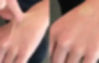 Cubit Tangan Bisa Tunjukkan Tubuh Dehidrasi atau Enggak! Kok Bisa?