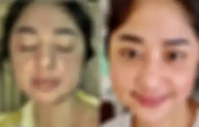 Langka dan Hanya Dirasakan 20 Persen Penderita Corona, Ruam di Wajah Dewi Perssik Cuma Dialami Beberapa Orang Saja: Kemerahan Ini Adalah Salah Satu yang Timbul