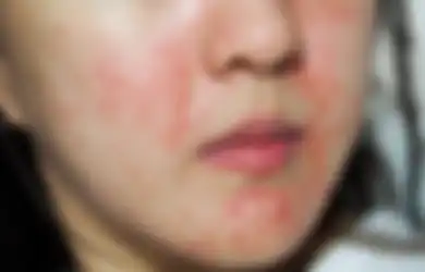Stop Lakukan 5 Kebiasaan Skincare Ini Buat Kulit Sensitif. Jadi Parah!