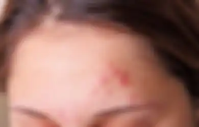 4 Penyakit Mental Ini Bisa Picu Timbulnya Jerawat Kronis di Wajah!