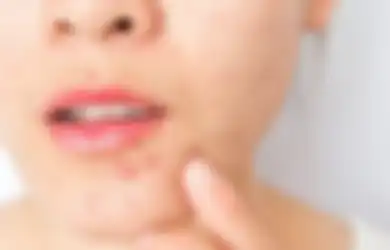 Jangan Lakukan! 5 Kesalahan Skincare Ini Memicu Wajah Breakout!