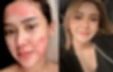 Akui Idap Autoimun Gara-gara Sering Suntik Putih, Cita Citata Kapok Gunakan Produk Kimia: Alangkah Baiknya untuk Beralih ke Herbal