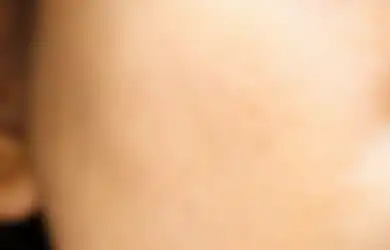 Biang Kerok Jerawat dan Komedo, Hindari 5 Skincare yang Menyumbat Pori Ini!