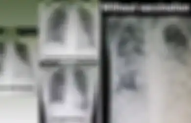 Unggah 4 Foto Rontgen Paru-paru, Dokter Ini Bongkar Kondisi Pasien Covid-19 yang Sudah dan Belum Divaksin, Perbandingannya Mencengangkan