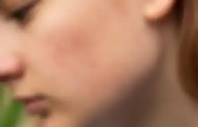 Mulus! Hempaskan Jerawat Bruntusan Pakai 3 Sabun Cuci Muka Murah Ini!