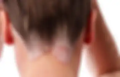 Hati-Hati, Covid-19 Lebih Berisiko Berbahaya pada Pasien Psoriasis