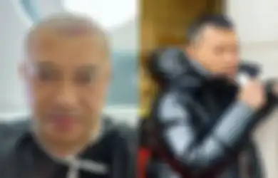 Penampilannya Berubah Drastis, Anang Hermansyah Ternyata Jalani Transplantasi Rambut di Turki, Apa Saja Efek Samping yang akan Terjadi?