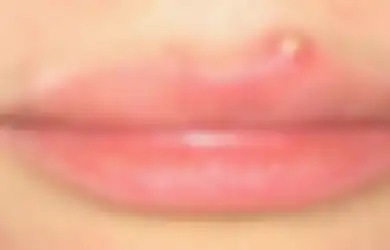 Ada Jerawat Di Bibir? Begini 5 Mudah Cara Menghilangkannya, Perhatikan