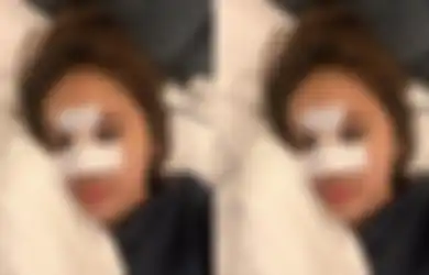 Niat Hati Ingin Mancungkan Hidung, Anak Artis Ini Justru Kena Apes, Kondisinya Setelah Operasi Plastik Justru Memprihatinkan hingga Impan yang Baru Dipasang Harus Dilepas