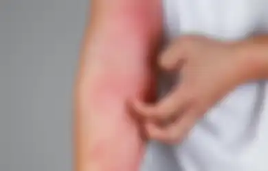 Awas, Gatal-Gatal di Kulit Bisa Jadi Pertanda Gejala Penyakit Ini!
