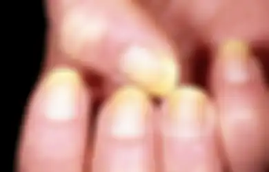 Selain Diabetes, Ini 5 Hal yang Bisa Menyebabkan Kuku Kuning!