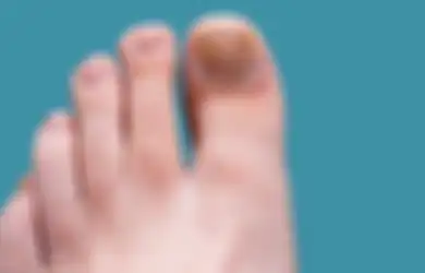Penyebab Kuku Kaki Menghitam, Awas Penyakit Jantung dan Ginjal