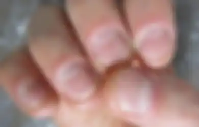 Hati-hati, 5 Penyakit Ini Ditandai Dengan Kuku Rapuh, Perhatikan