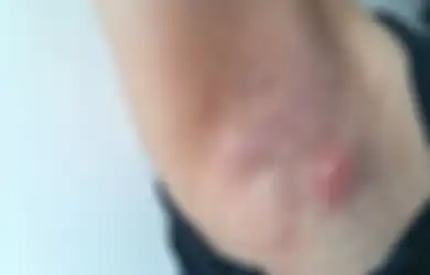 Cegah Jerawat Tumbuh di Ketiak, Harus Terapkan 6 Hal Penting Ini!