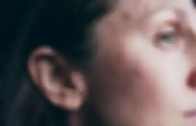 Udah Gede Masih Jerawatan? Ternyata Ini 11 Penyebab Adult Acne!