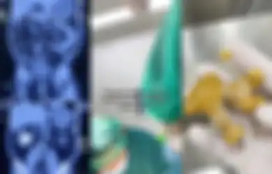2 Tahun Nyeri Pinggang Tak Sembuh-sembuh, Wanita Ini Ternyata Simpan Benda Mengerikan Sebesar Jahe di dalam Tubuhnya, Kebiasaan Sepele Jadi Gara-garanya
