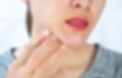 Harus Tahu, Inilah 4 Makanan yang Bisa Menyebabkan Jerawat Diwajah