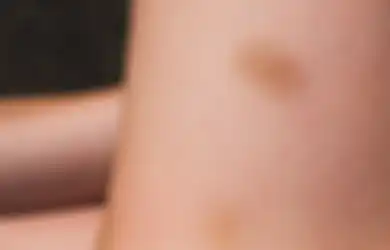 Bukan Luka, Ini 3 Penyebab Munculnya Memar di Kulit Secara Tiba-tiba