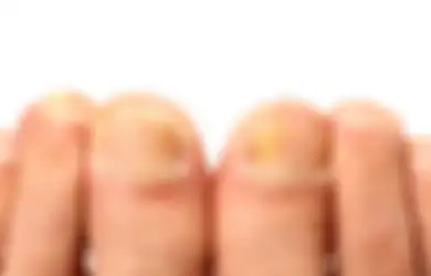 Selain karena Kena Kunyit, Ini 5 Penyebab Kuku Kuning. Diabetes?