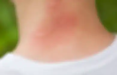 Ini 5 Cara Menghilangkan Rasa Gatal Akibat Bekas Gigitan Nyamuk