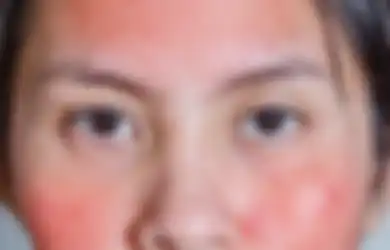 Enggak Cuma Jerawat, Ini 15 Penyebab Kemerahan di Kulit Wajah