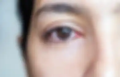 Selain Debu, Ini 4 Hal Penyebab Mata Berair. Apakah Berbahaya?