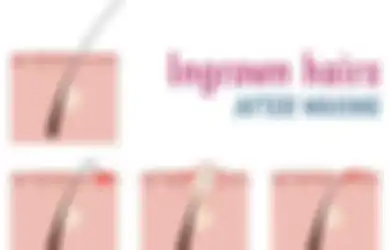Ini Penyebab Ingrown Hair Alias Benjolan di Area Vagina, Perhatikan