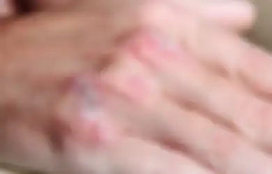 Eksim Itu Bukan Penyakit Gatal Karena Jamur, Bro. Ini 5 Hal Yang Perlu Kamu Ketahui 