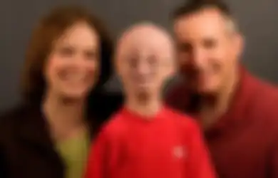 6 Hal yang Harus Diketahui dari Sam Berns yang Menderita Penyakit Genetik Progeria (2)