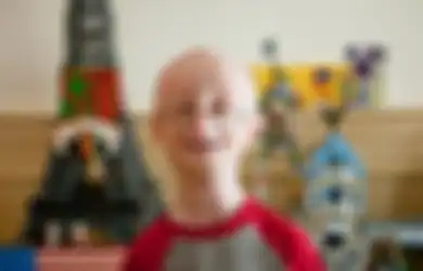 6 Hal yang Harus Diketahui dari Sam Berns yang Menderita Penyakit Genetik Progeria (1)