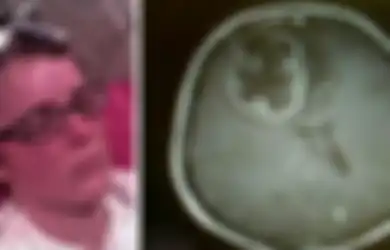 Dokter Berhasil Mengobati Tumor Otak dengan Polio Virus