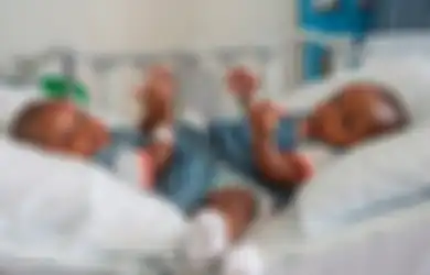 Kedua Bayi Kembar Siam Asal Nigeria Ini Berhasil Dipisahkan