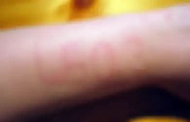 Bukan karena Makanan, 5 Alergi Ini Dipicu oleh Hal-hal Sangat Tak Terduga