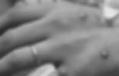 Monkeypox, Virus Berbahaya Layaknya Cacar Namun Belum Ditemukan Obatnya