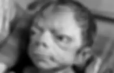 Terkena Sindrom Aneh, Bayi Ini Mempunyai Wajah Seperti Kakek-kakek Usia 80 Tahun!