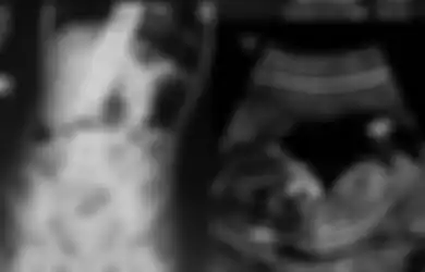Dikira Tumor, Ternyata Dokter Temukan Bayi di Dalam Perut Gadis Berusia 8 Tahun, Terungkap Fakta Memilukan Dibaliknya