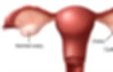 Nyeri Perut Tak Kunjung Sembuh,  Ternyata Kista Ovarium Sebesar 18 Kg Tumbuh di Perut Wanita India Ini Sampai Sulit Napas