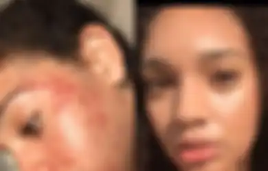 Wanita Ini Berhasil Obati Jerawatnya Selama 30 Hari, Perawatan Alaminya Ini Kini Banyak Ditiru Orang