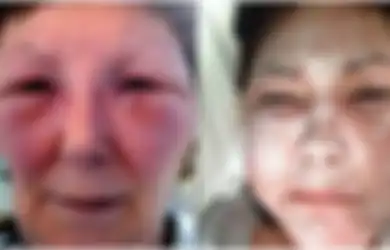 Wajah Wanita Ini Membeku Setelah Suntik Botoks dengan Bantuan Dokter Gadungan!