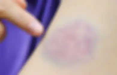 Ini 5 Gejala Leukemia Seperti yang Diidap Dian Pramana Poetra, Salah Satunya Memar