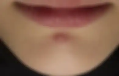 Muncul Jerawat di Dagu? Begini Penyebab dan Cara Mengatasinya!
