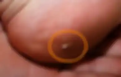 Bawang Merah Bisa Keluarkan Duri dari Kulit dengan Mudah, Ini Triknya