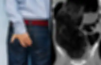 Jangan Suka Tunda Buang Air Besar, Pria Ini Nyaris Mati karena Sembelit