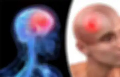 Anak Marcella Zalianty Terkena Tumor Otak, Ini 7 Gejala Tumor Otak, Salah Satunya Sakit Kepala
