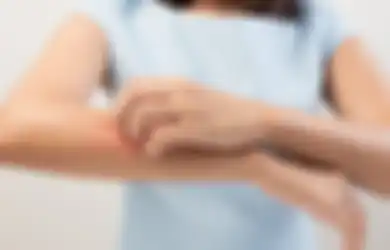 Tak Perlu Panik Saat Alami Biduran, Ini 3 Resep Obat Herbal yang Bisa Digunakan