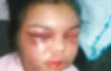 Tragisnya Nasib Adolfina yang Selalu Dipukuli Suaminya Setiap Mendapat ‘Like’ di Facebook