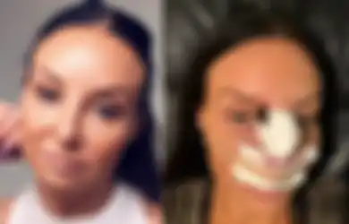 Puluhan Juta Terbuang Karena Operasi Plastik Hidungnya Gagal, Bentuk Hidung Wanita ini Pulih Kembali dengan Bantuan Lintah