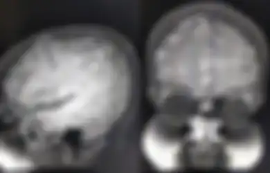 Kisah Orang-orang yang Tubuhnya Jadi Sarang Cacing Pita, Salah Satu Penyebabnya Sering Dianggap Sepele